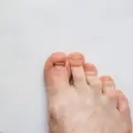 Ongle d’orteil arraché : quoi faire après un traumatisme?