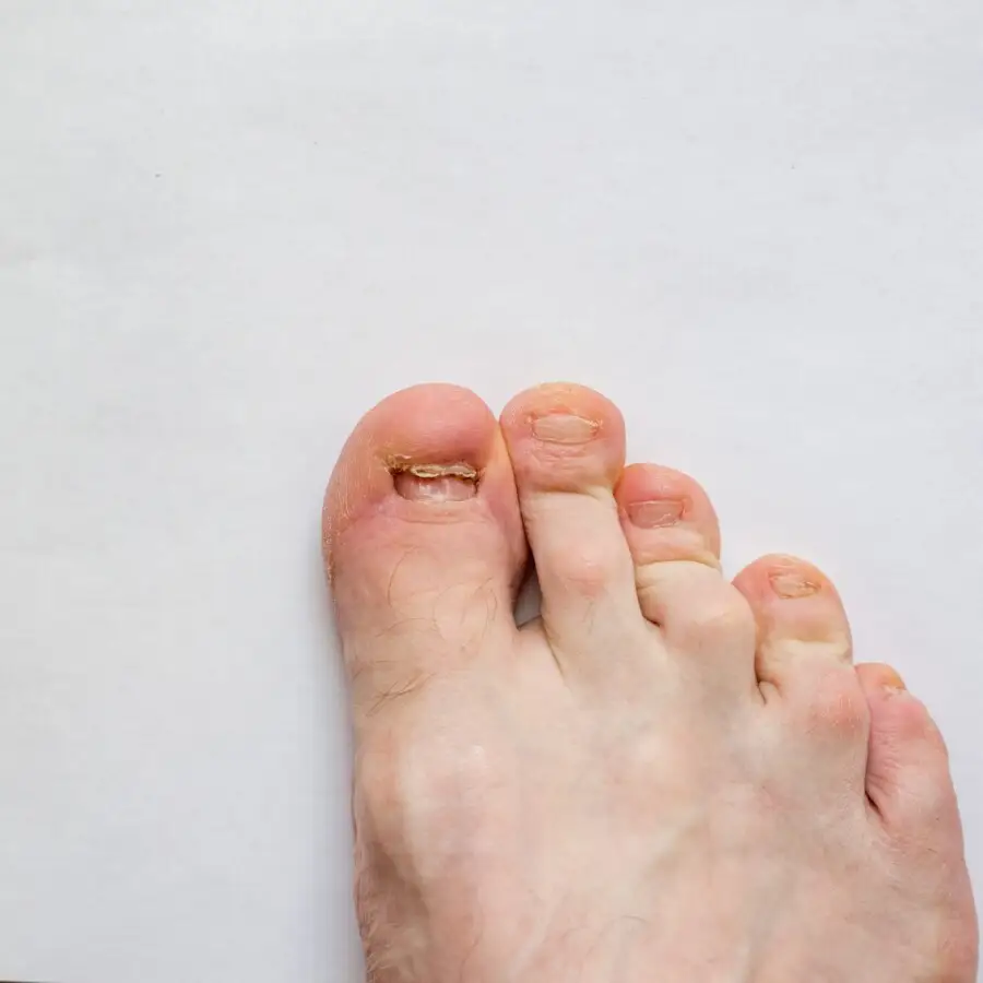 Image de :Ongle d’orteil arraché : quoi faire après un traumatisme?