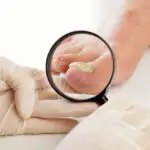 Le diagnostic de l’onychomycose par analyse moléculaire