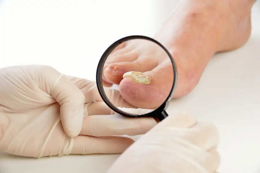 Image de :Le diagnostic de l’onychomycose par analyse moléculaire