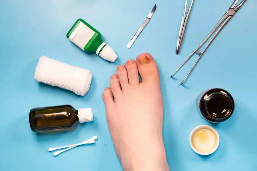 Image de :Quand choisir la chirurgie pour un ongle incarné