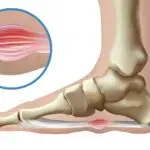 Fibrome plantaire : causes, symptômes et traitement en podiatrie