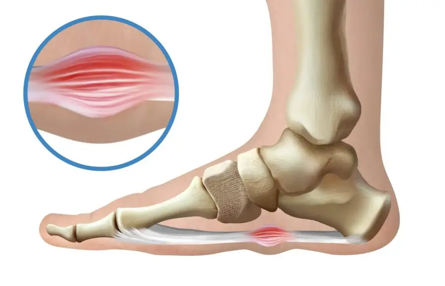 Image de :Fibrome plantaire : causes, symptômes et traitement en podiatrie