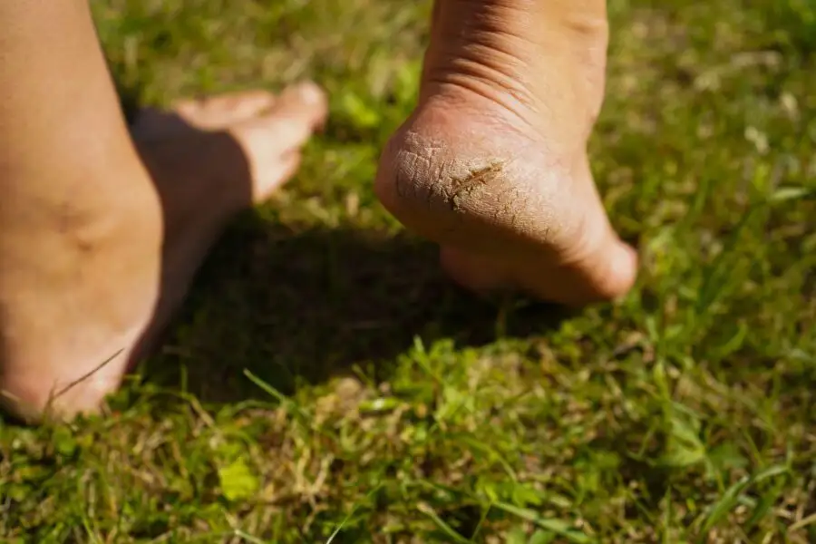 Image de :Peau sèche aux pieds : pourquoi vos talons craquent au printemps