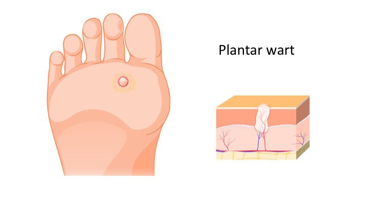 How do I treat my plantar warts at home?