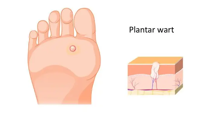 How do I treat my plantar warts at home?