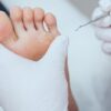 Corns, calluses and severe corns