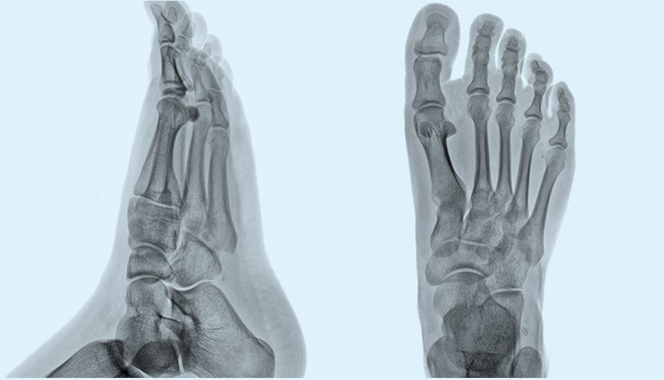 Radiographie de pied