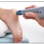 Thérapie par ondes de choc des pieds