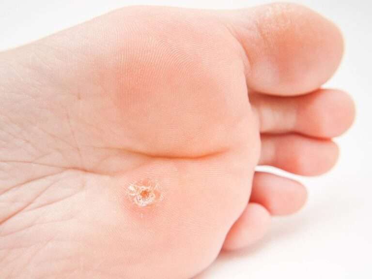 Image de :Common and plantar warts