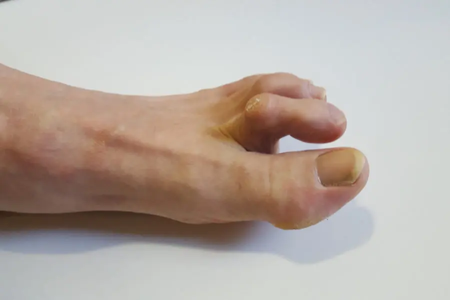 Hammer toe