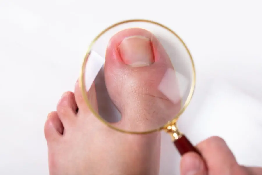 Ingrown toenail (onychocryptosis)