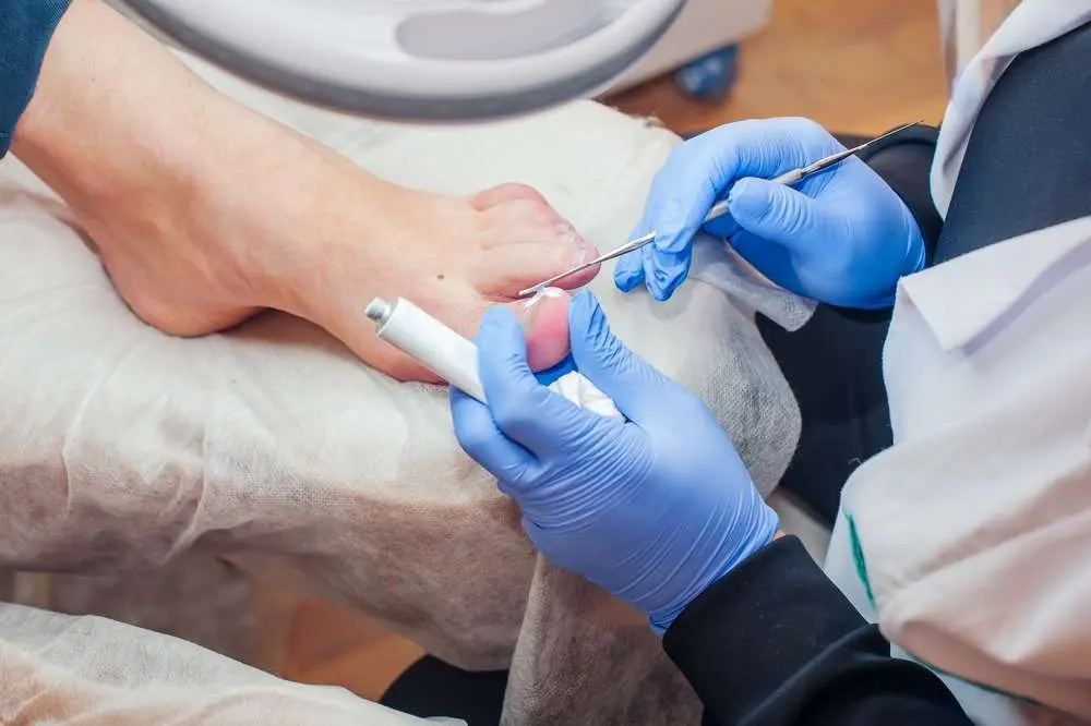 Traitement des ongles incarnés