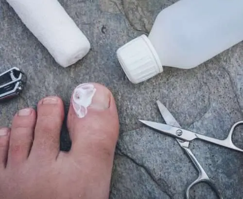 Picture of ingrown toenail post surgery