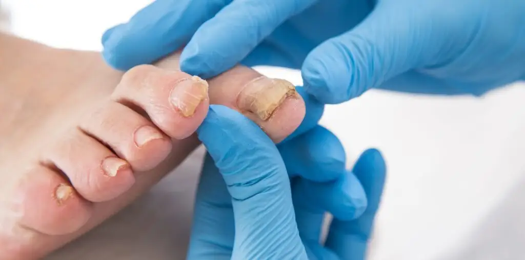 Comment prévenir l’infection par la mycose des ongles?