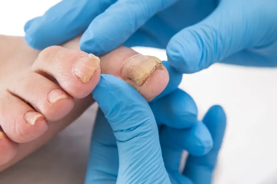 Comment prévenir l’infection par la mycose des ongles?