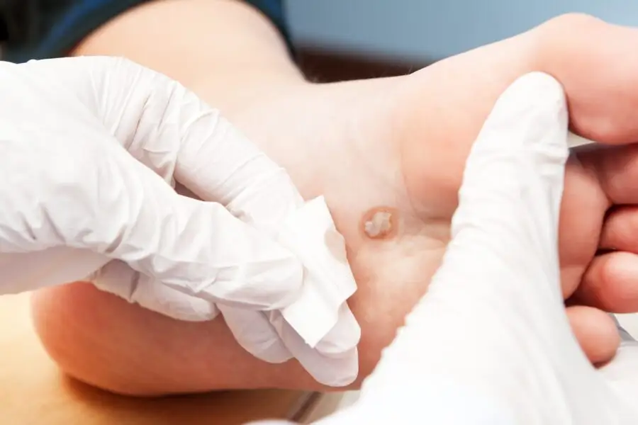 Quand consulter un podiatre pour ma verrue plantaire ?