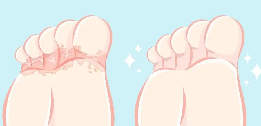 Le pied d’athlète : tout ce que vous devez savoir sur cette infection