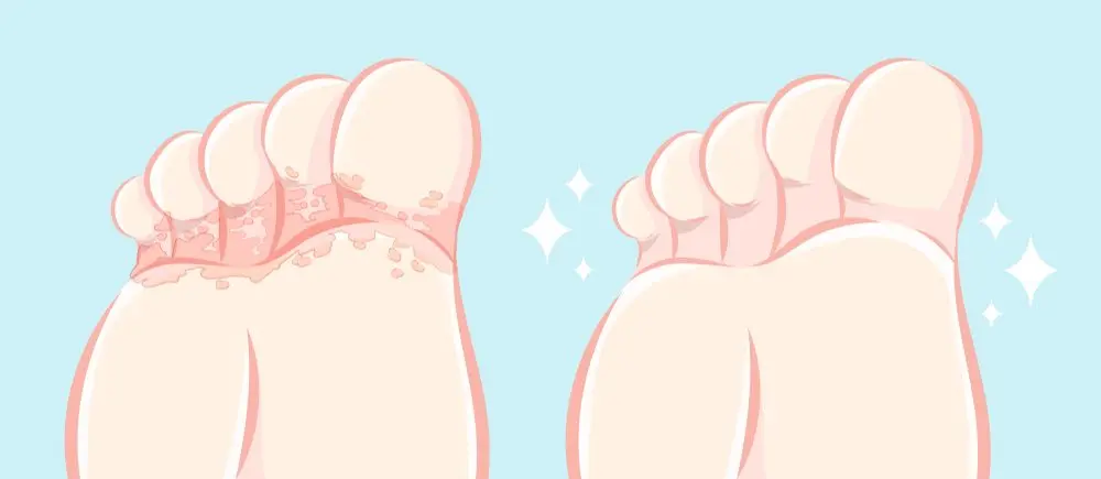 Le pied d’athlète : tout ce que vous devez savoir sur cette infection