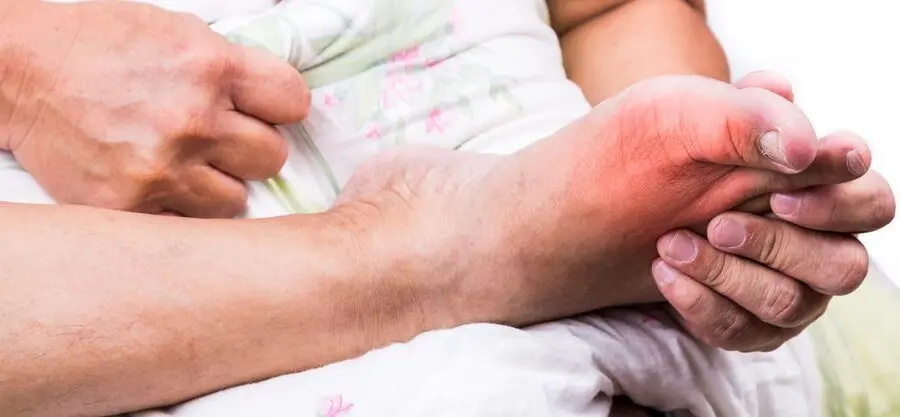 La goutte au pied : 5 signes à surveiller