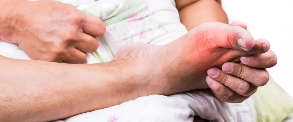 La goutte au pied : 5 signes à surveiller