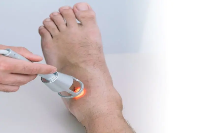 Traitement laser thérapeutique du pied