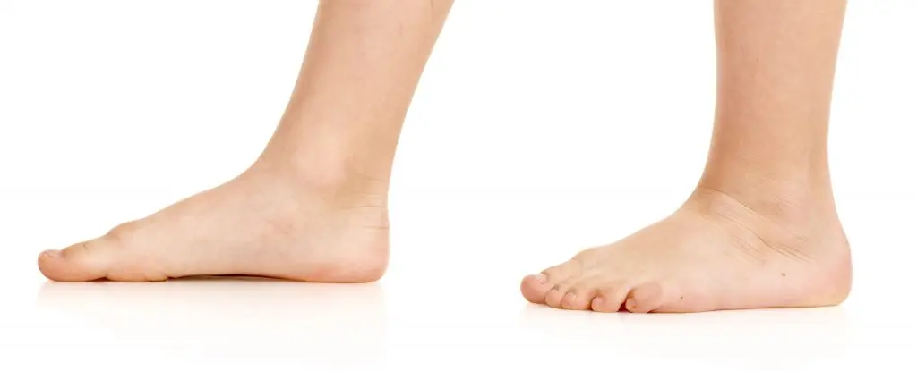 Comment reconnaître un pied plat chez l’enfant ?