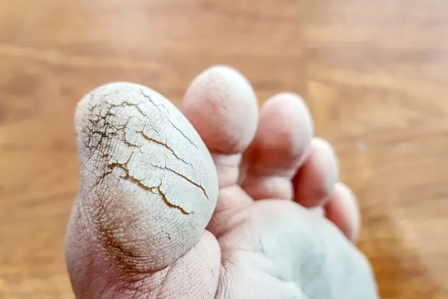 Crevasses Au Pied Cause Symptome Et Traitement Piedreseau Crevasses Au Pied Cause Symptome Et Traitement Piedreseau