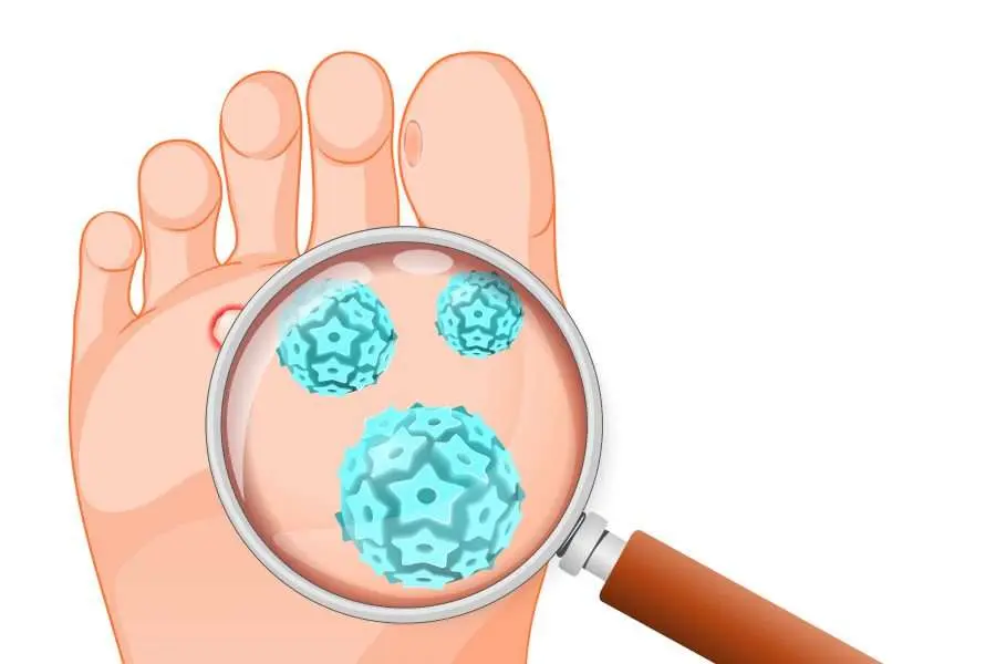 What are the different kinds of plantar warts?