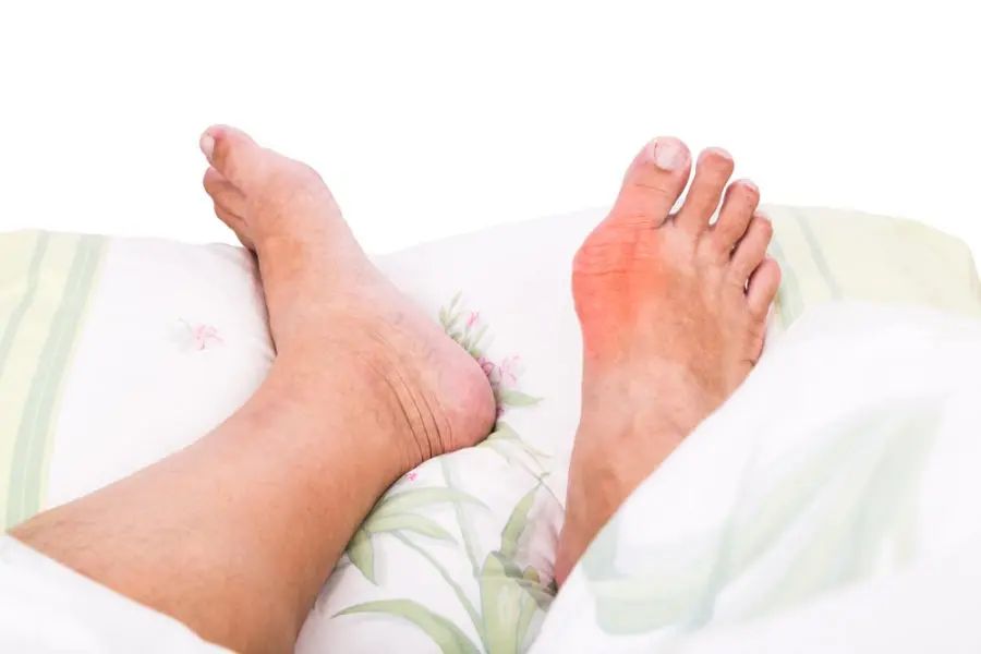 Foot arthritis