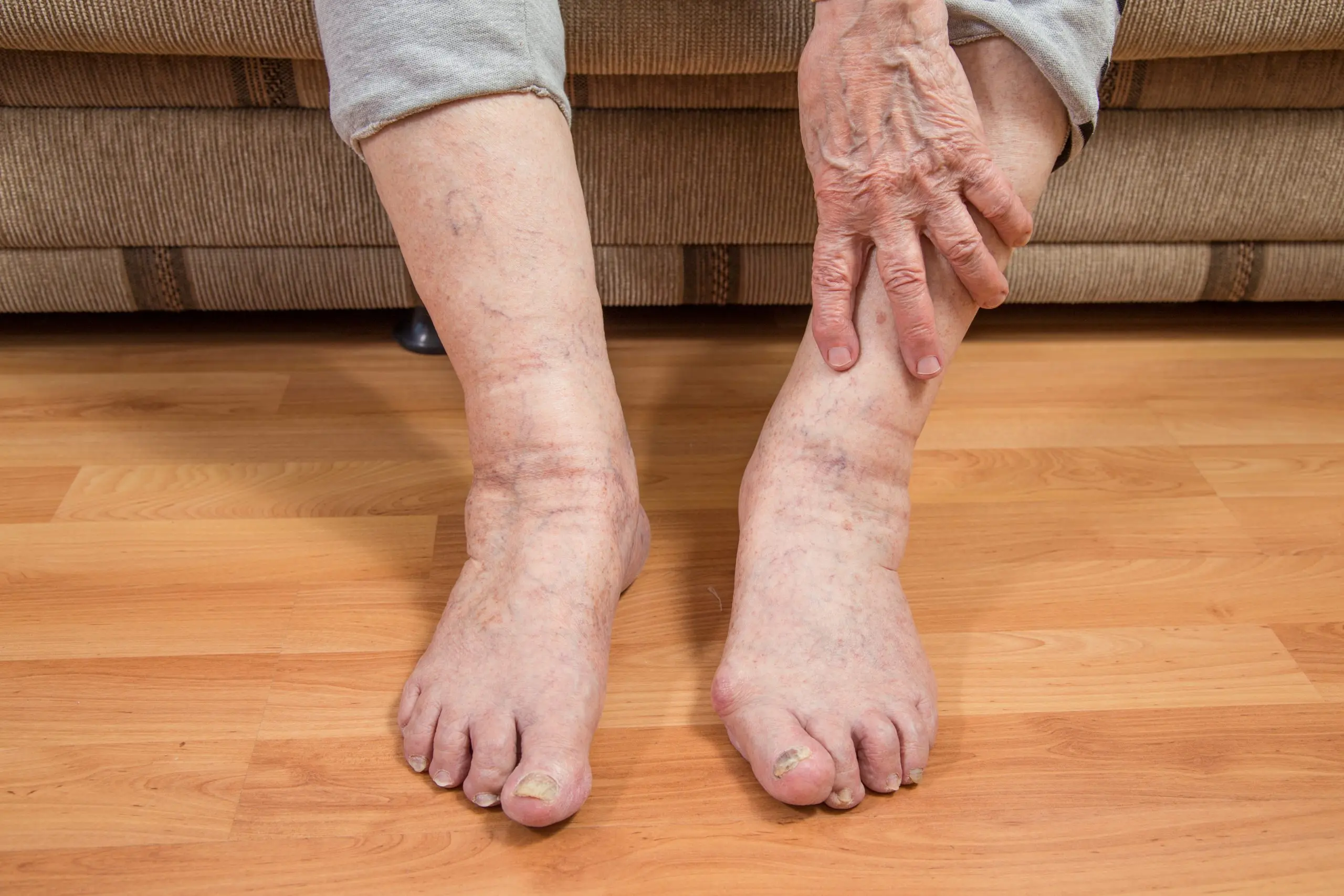 Les Deformations Du Pied Cause Et Traitement Piedreseau Les Deformations Du Pied Cause Et Traitement Piedreseau