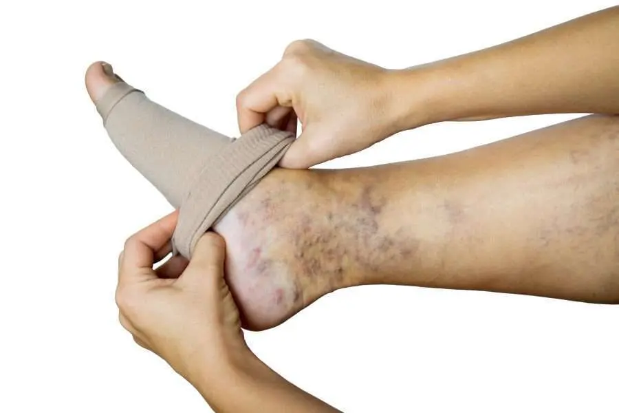 Les troubles d’insuffisance veineuse dans les jambes