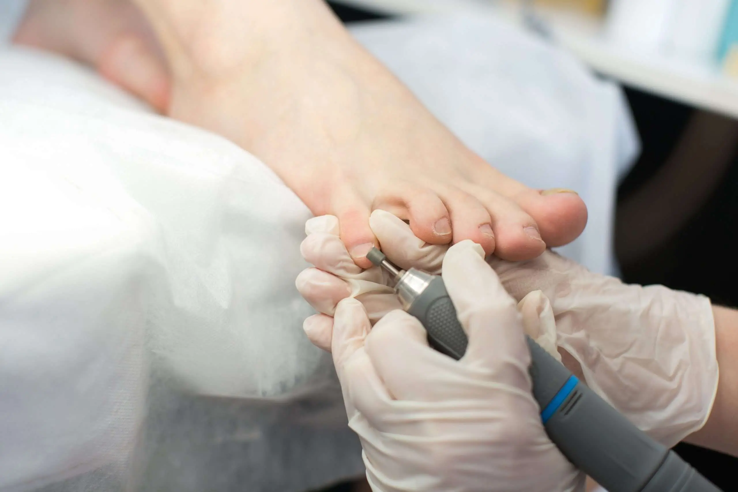 Les Ongles D Orteils Epais Et Difformes Piedreseau Les Ongles D Orteils Epais Et Difformes Piedreseau