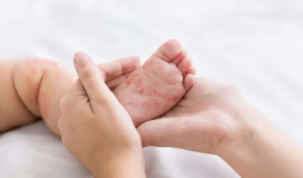 Trois maladies rares du pied à connaître
