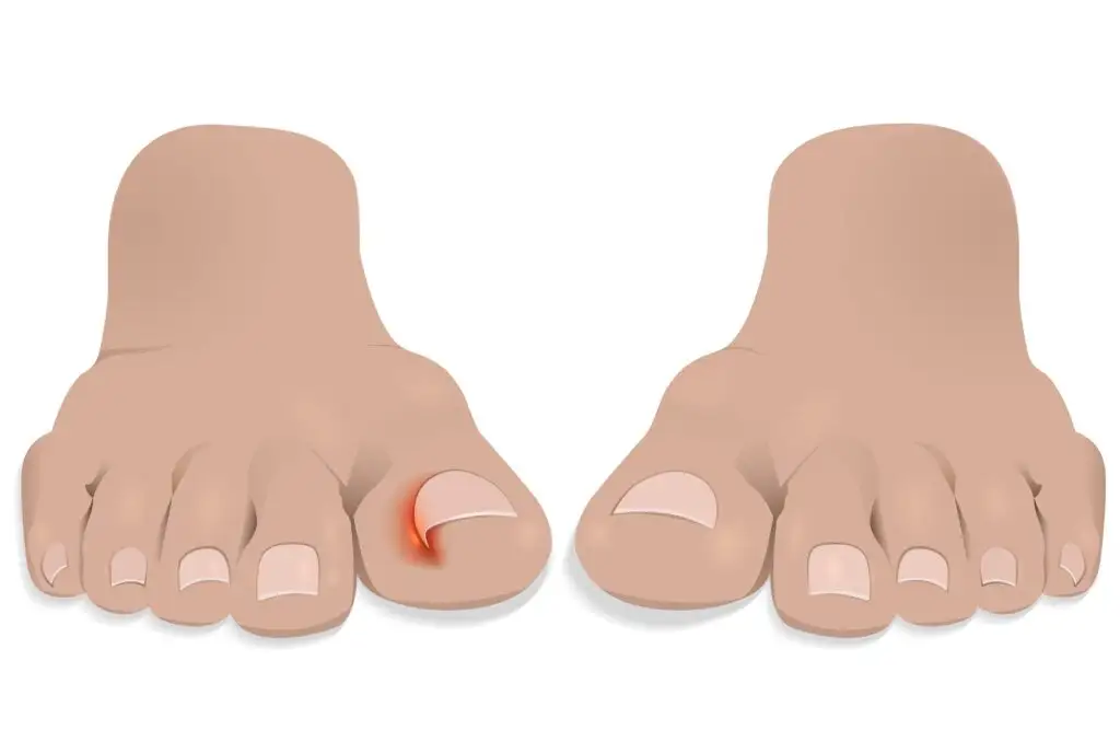 Comment traiter un ongle incarné à la maison ?