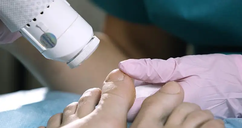 traitement laser ongle mycose champignon onychomycose
